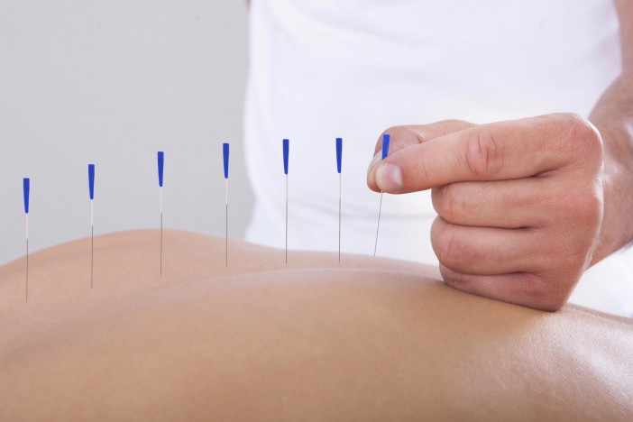 L'acupuncture, comment ça marche et ses bienfaits ?